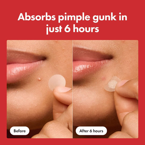 Pimple Patch Acne Remover